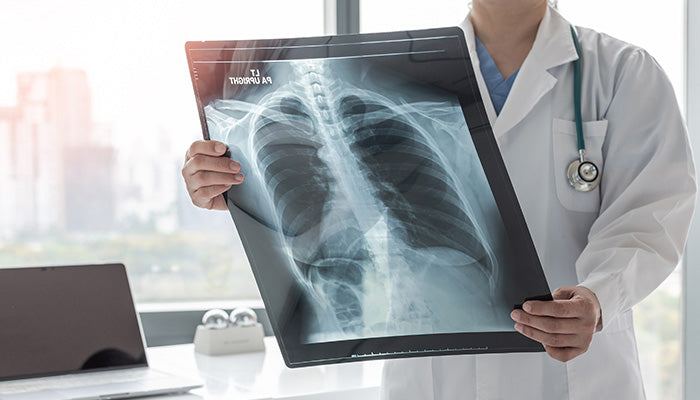 ¿La fibrosis quística es hereditaria?