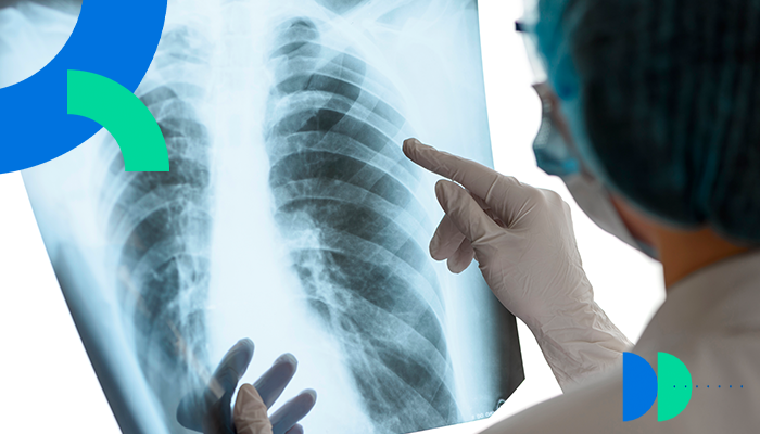 ¿Sabes qué es la fibrosis pulmonar idiopática?