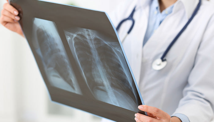 Fibrosis pulmonar idiopática: síntomas y factores de riesgo